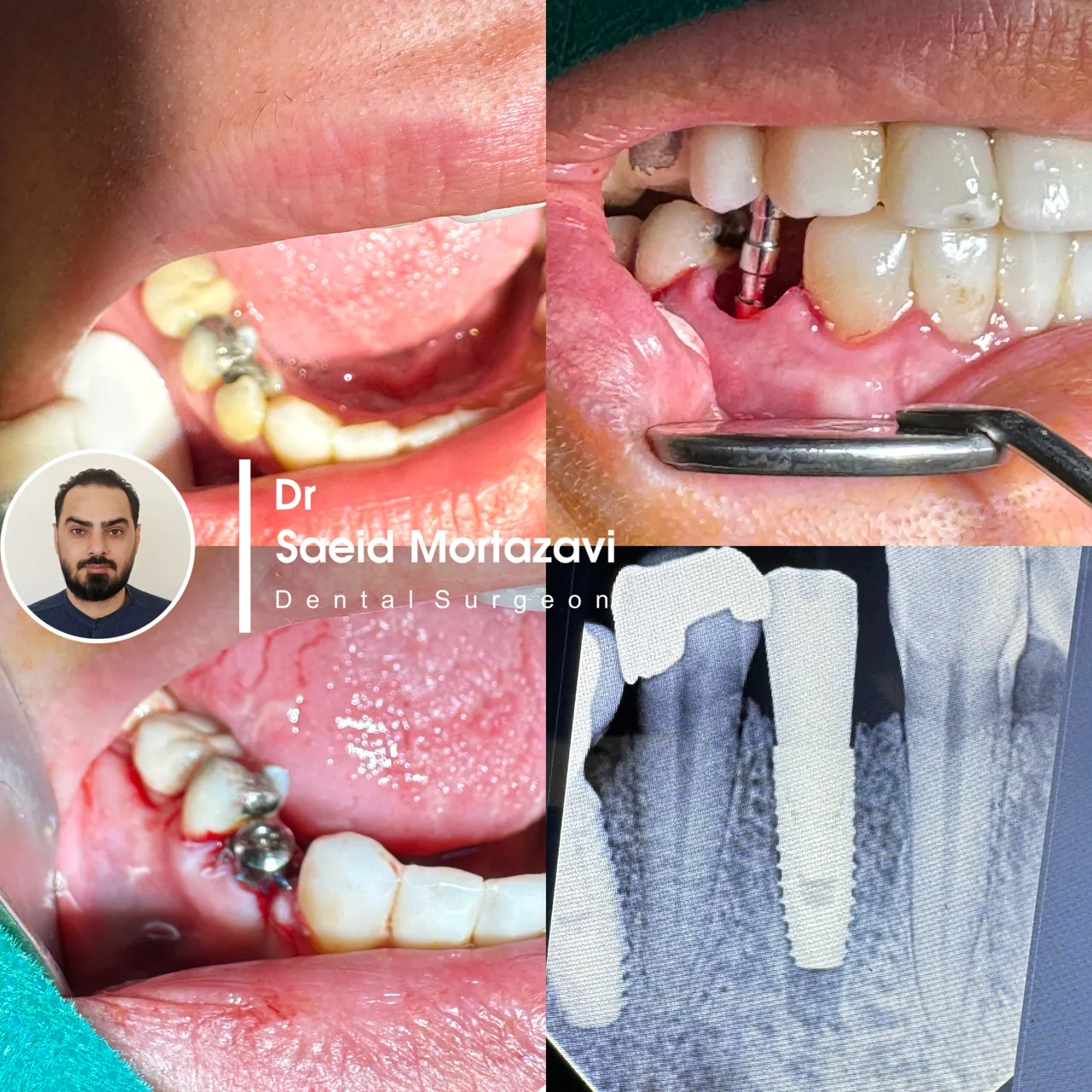 دندانپزشکی دکتر سعید مرتضوی و دکتر فرناز همتی - دندانپزشک در کرج - تصویر 4