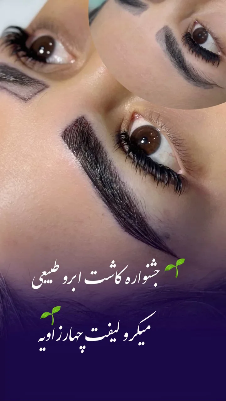 کاشت ابرو پرتراکم پارمیدا