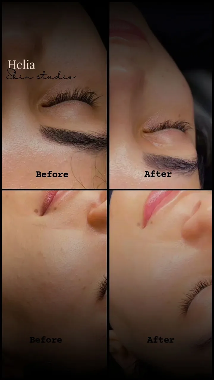 فیشیال و پاکسازی پوست هلیا - تصویر 2