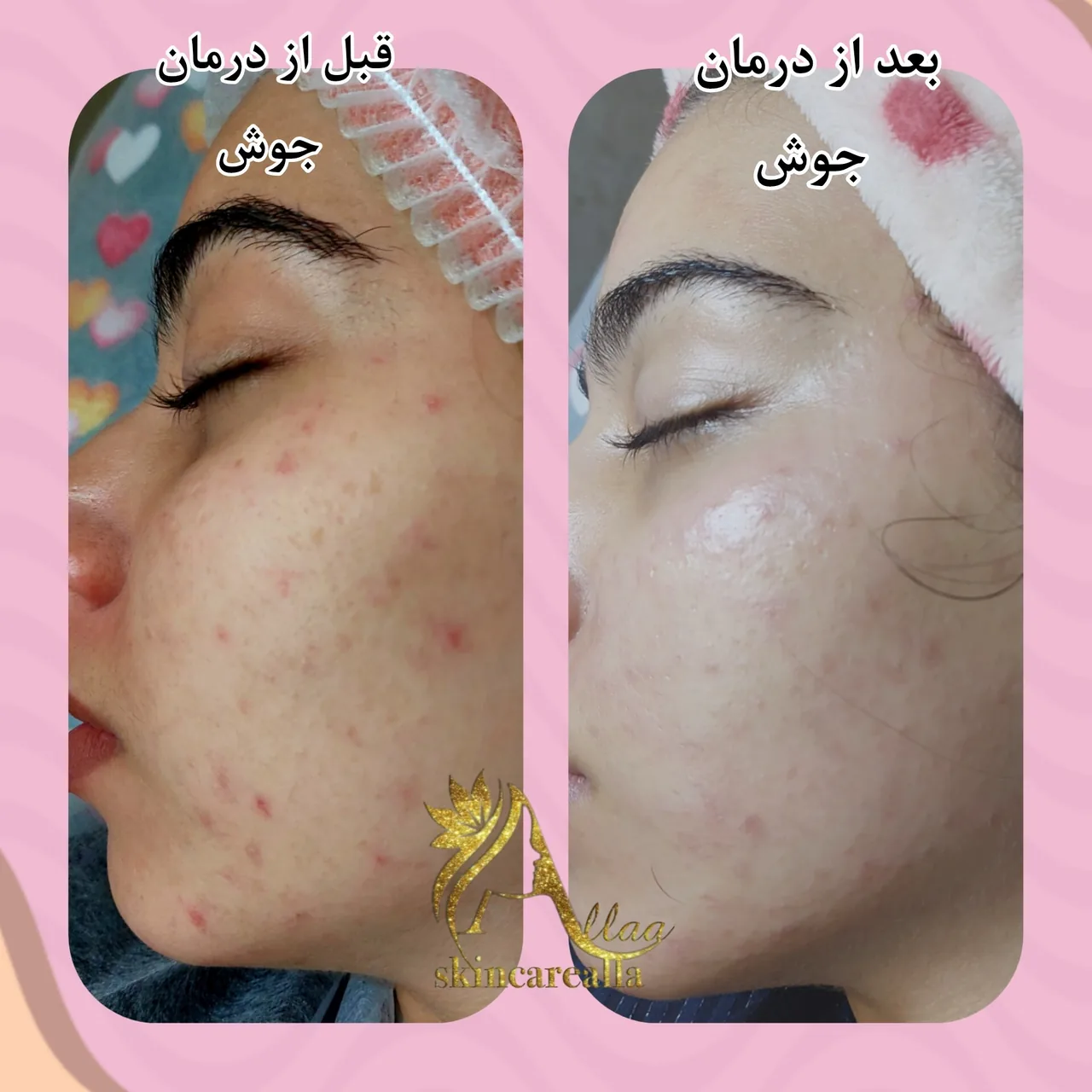کلینیک پاکسازی وفیشیال پوست آلا بانو - تصویر 4