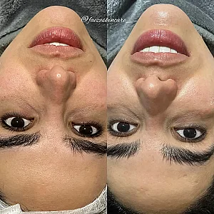 فیشال و پاکسازی پوست