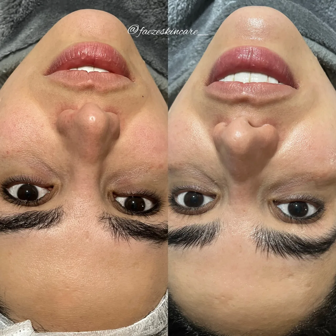 فیشال و پاکسازی پوست