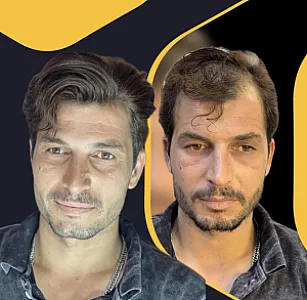 مرکز تخصصی پروتزمو و ترمیم مو(ایران مو) در اصفهان