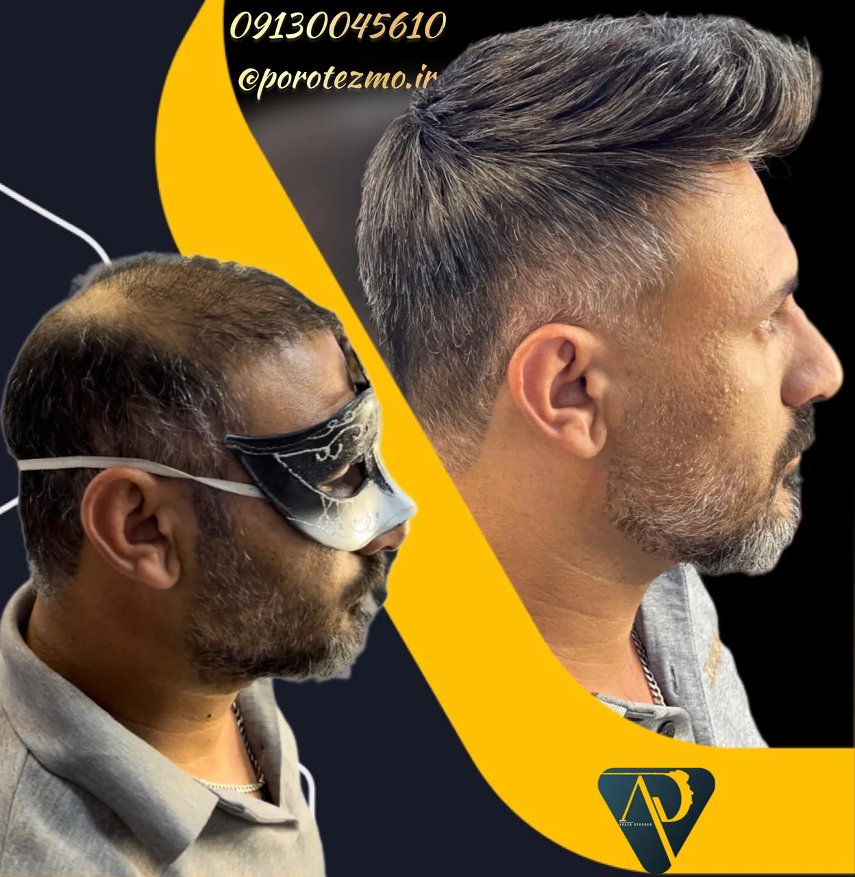 مرکز تخصصی پروتزمو و ترمیم مو(ایران مو) در اصفهان - تصویر 4