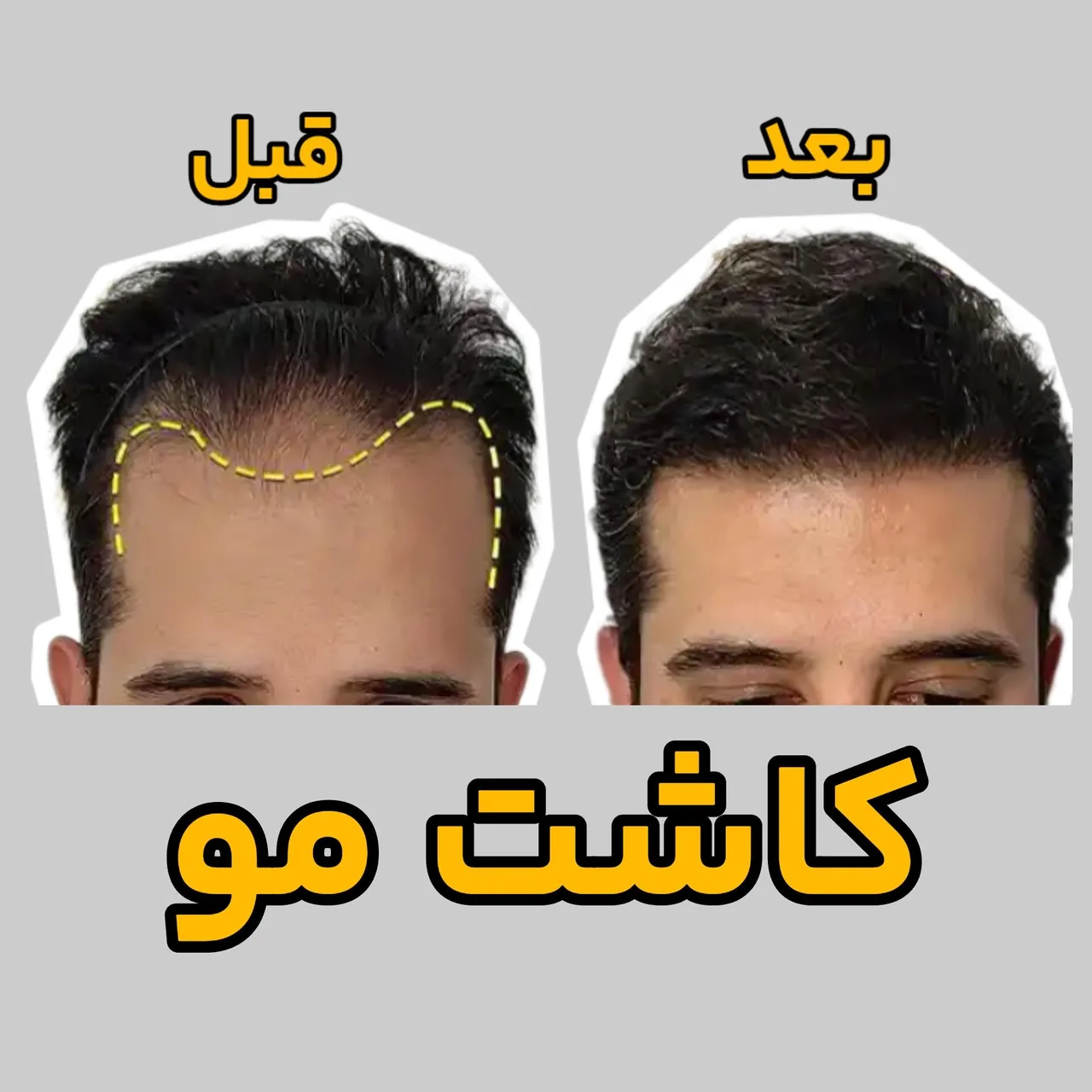 کاشت مو کرمان دکتررضاسعیدی - پزشک عمومی در کرمان - تصویر 2