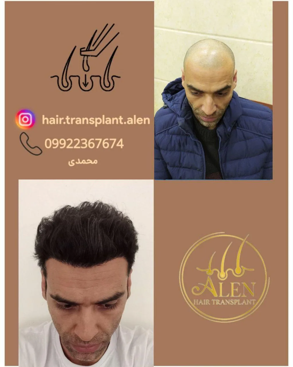 کلینیک کاشت موی آلن ارزو‌ محمدی