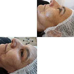 پاکسازی پوست وفیشال تخصصی فاطیما