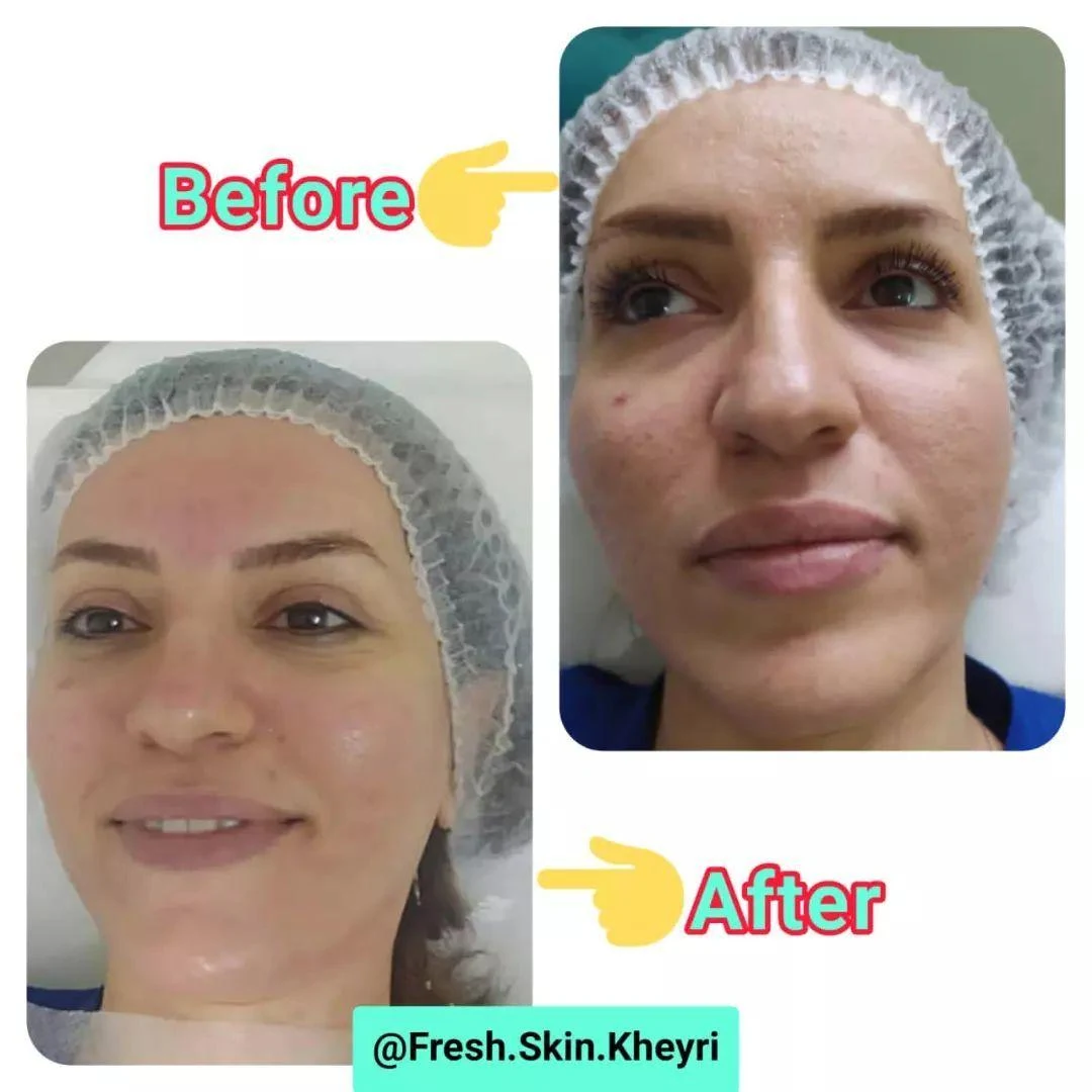 فشیال و پاکسازی تخصصی پوست آرامیس - تصویر 5