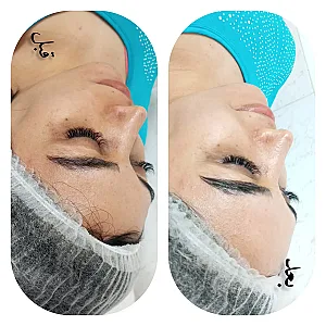 فیشیال و پاکسازی پوست ندا