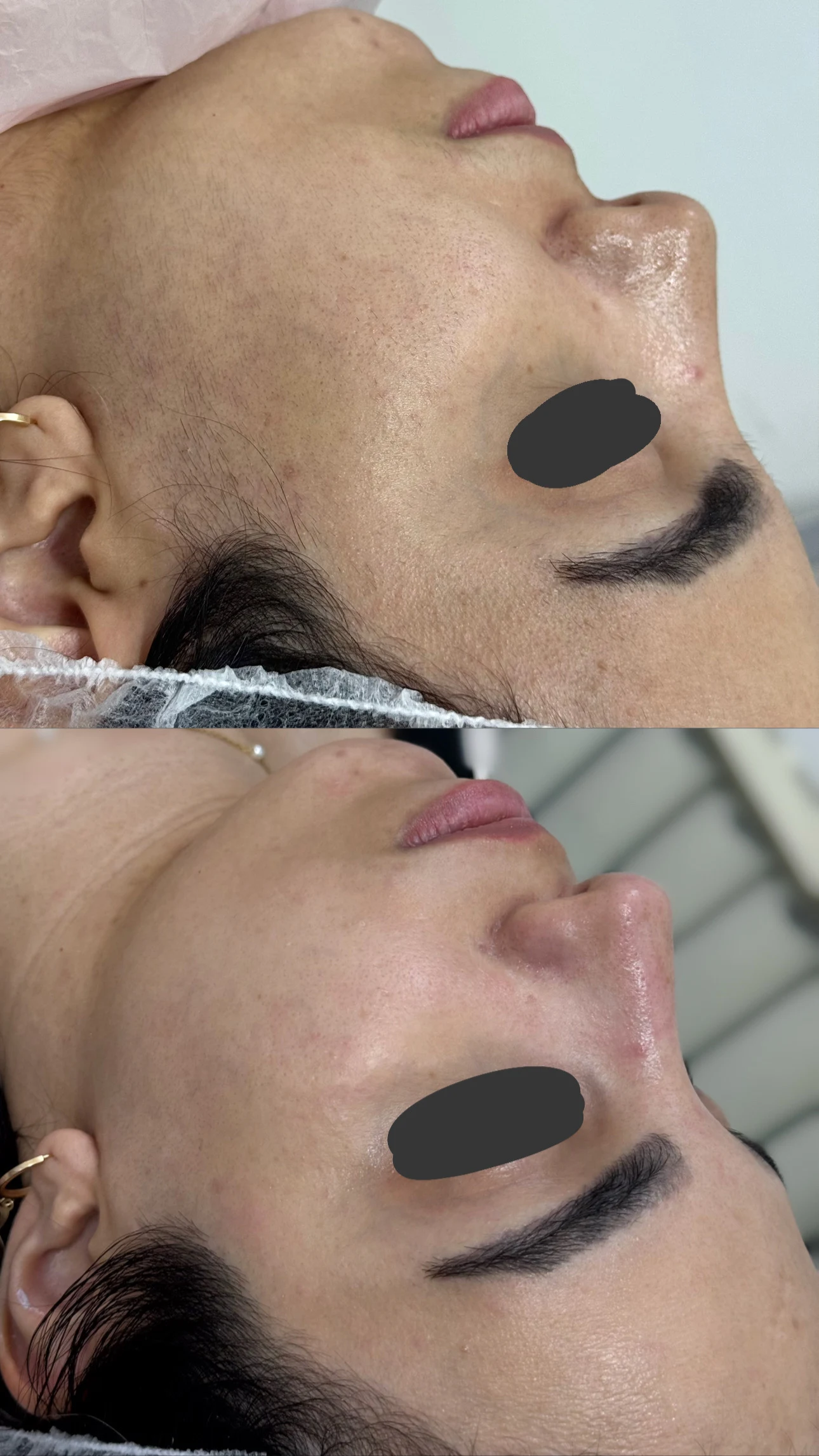 خدمات درماپلنینگ vip با اصلاح ابروی رایگان - تصویر 2