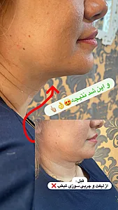 لاغری موضعی سعادت