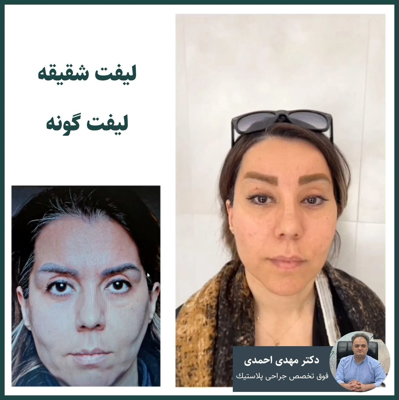 دکتر مهدی احمدی فوق تخصص جراحی پلاستیک - کلینیک پوست و زیبایی در تهران - تصویر 4
