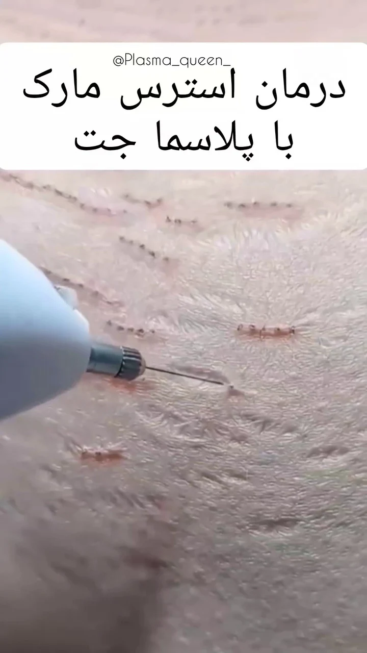 خدمات تخصصی فیشال و پلاسماجت نگین - آرایشگاه زنانه در تهران - تصویر 2