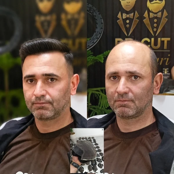 پروتز مو دکتر کات - تصویر 6