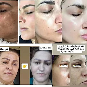 کرم ضدلک وسفیدکننده vip