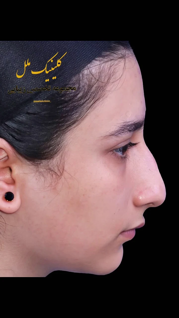 عمل بینی ملل کلینیک
