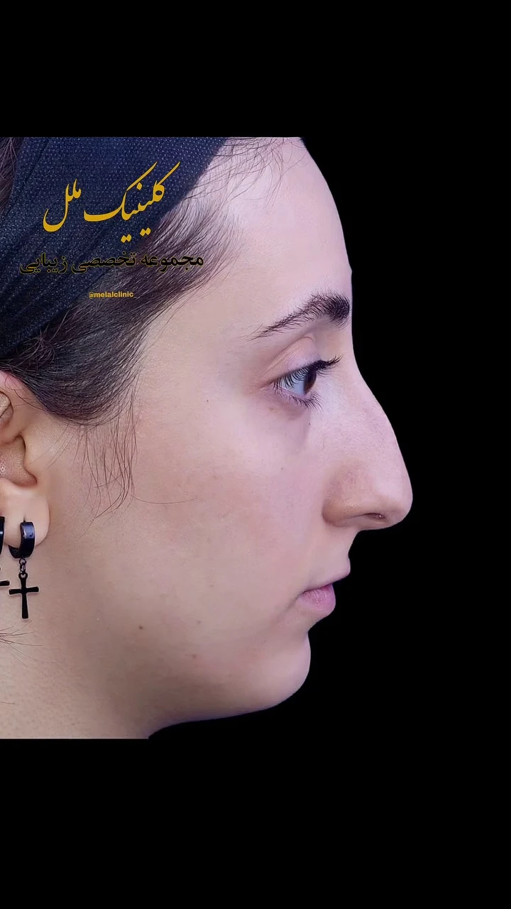 عمل بینی ملل کلینیک - تصویر 2