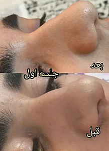 پلاسمای صورت  و چربی سوزی بینی