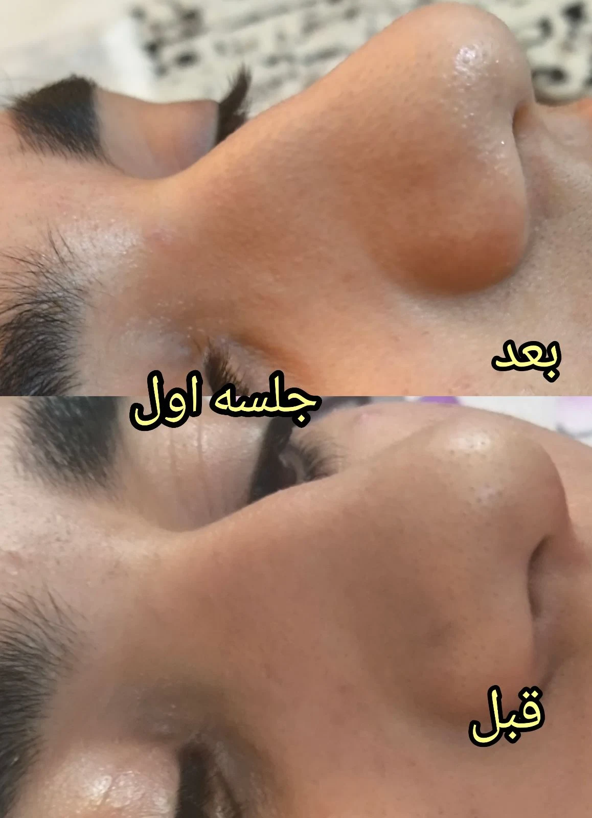 پلاسمای صورت  و چربی سوزی بینی - آرایشگاه زنانه در تهران