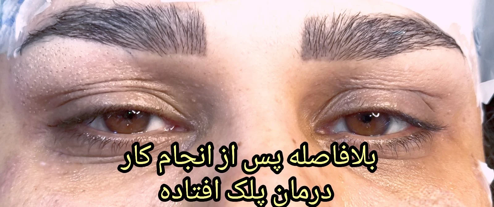 پلاسمای صورت  و چربی سوزی بینی - آرایشگاه زنانه در تهران - تصویر 2