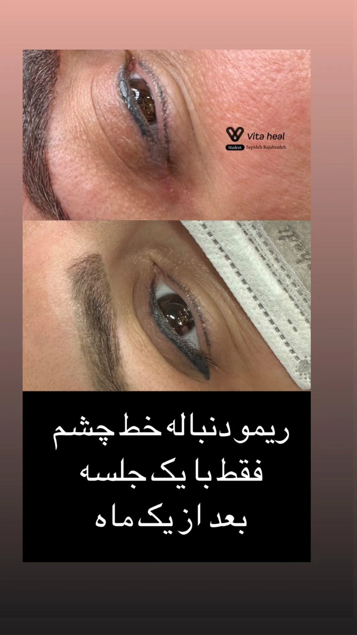 آکادمی ریموو تاتو سپیده رجب زاده