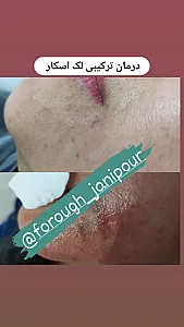 فیشال و درمان لک و اسکارو جوش