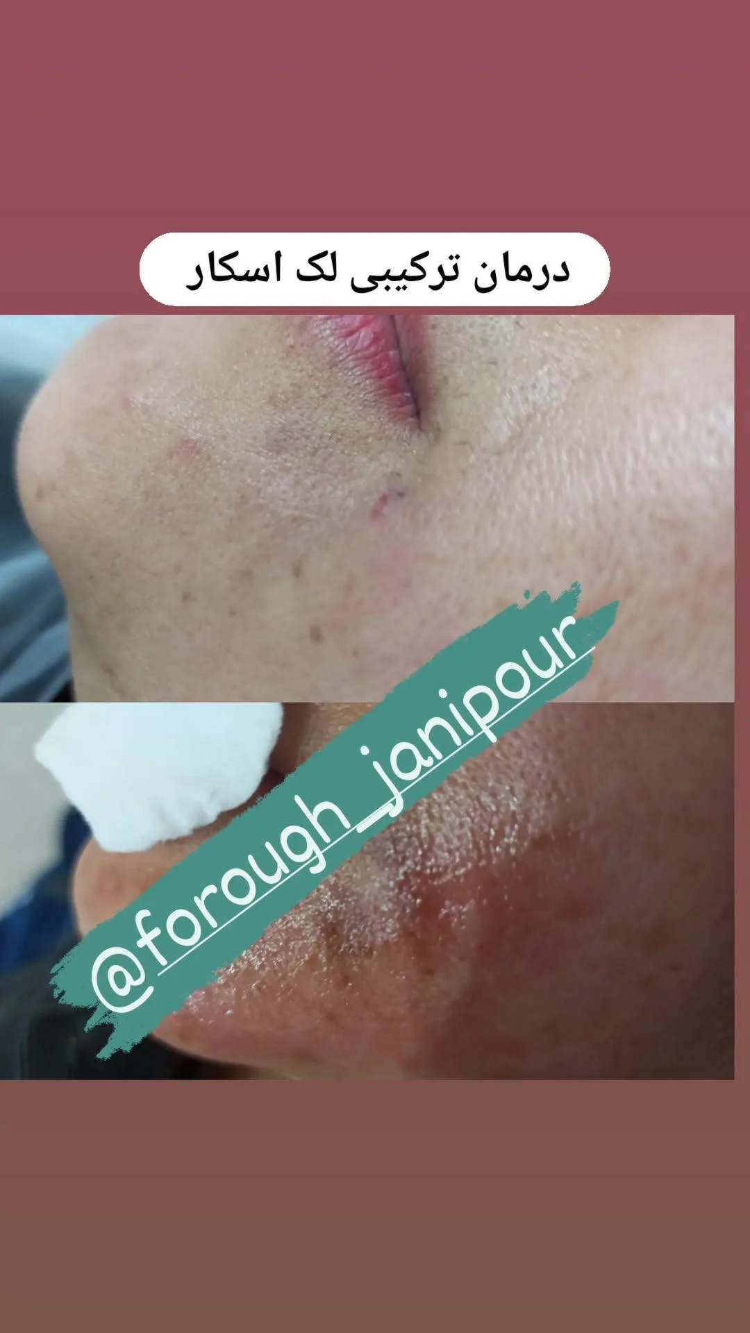 فیشال و درمان لک و اسکارو جوش