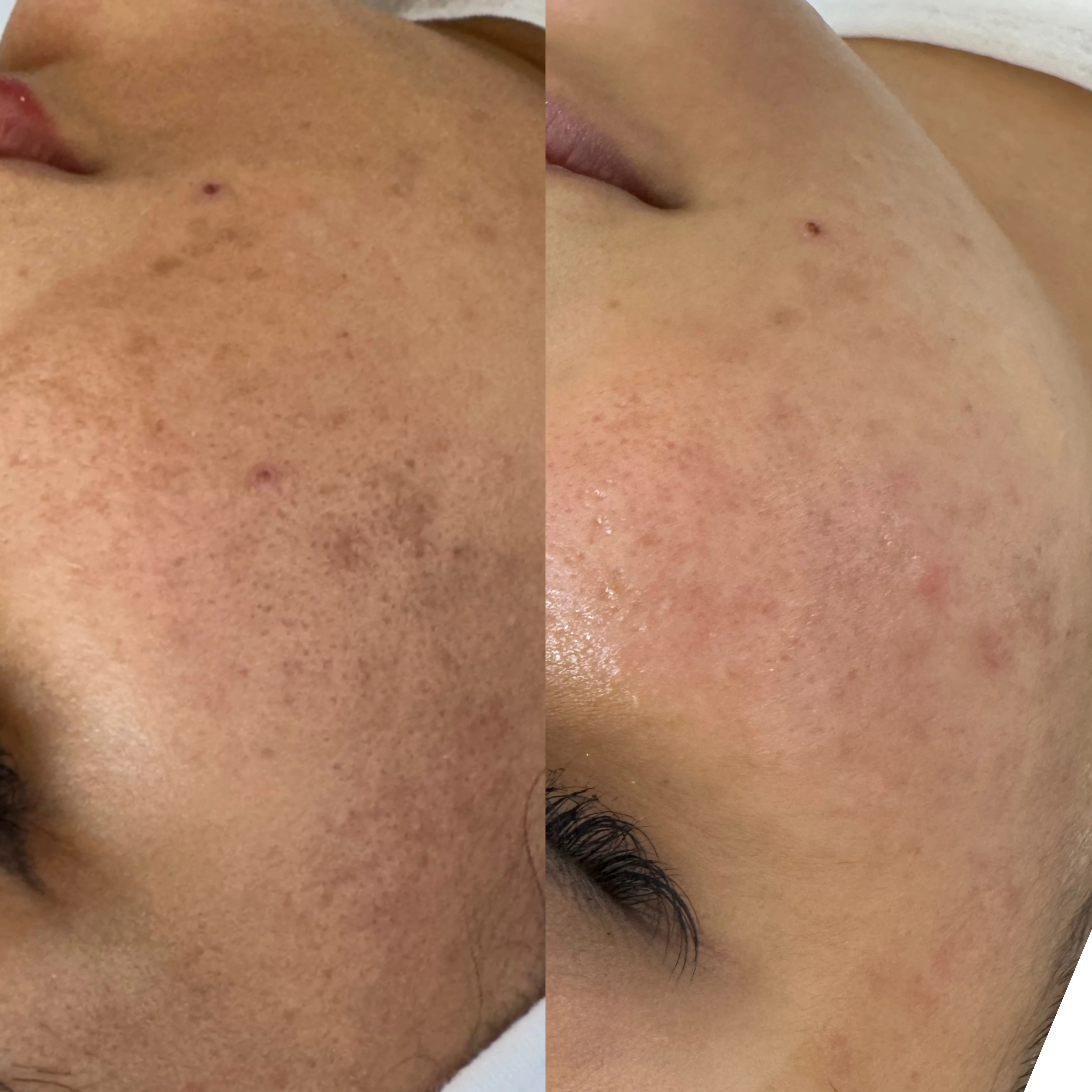 فیشال و پاکسازی پوست  آیلار شاهوردی - آموزشگاه آرایشگری در شهرکرد