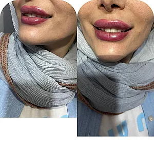 خدمات ژل و بوتاکس دکتر صالحی
