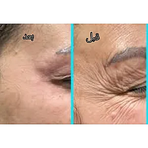 تزریقات ژل و بوتاکس داداشی