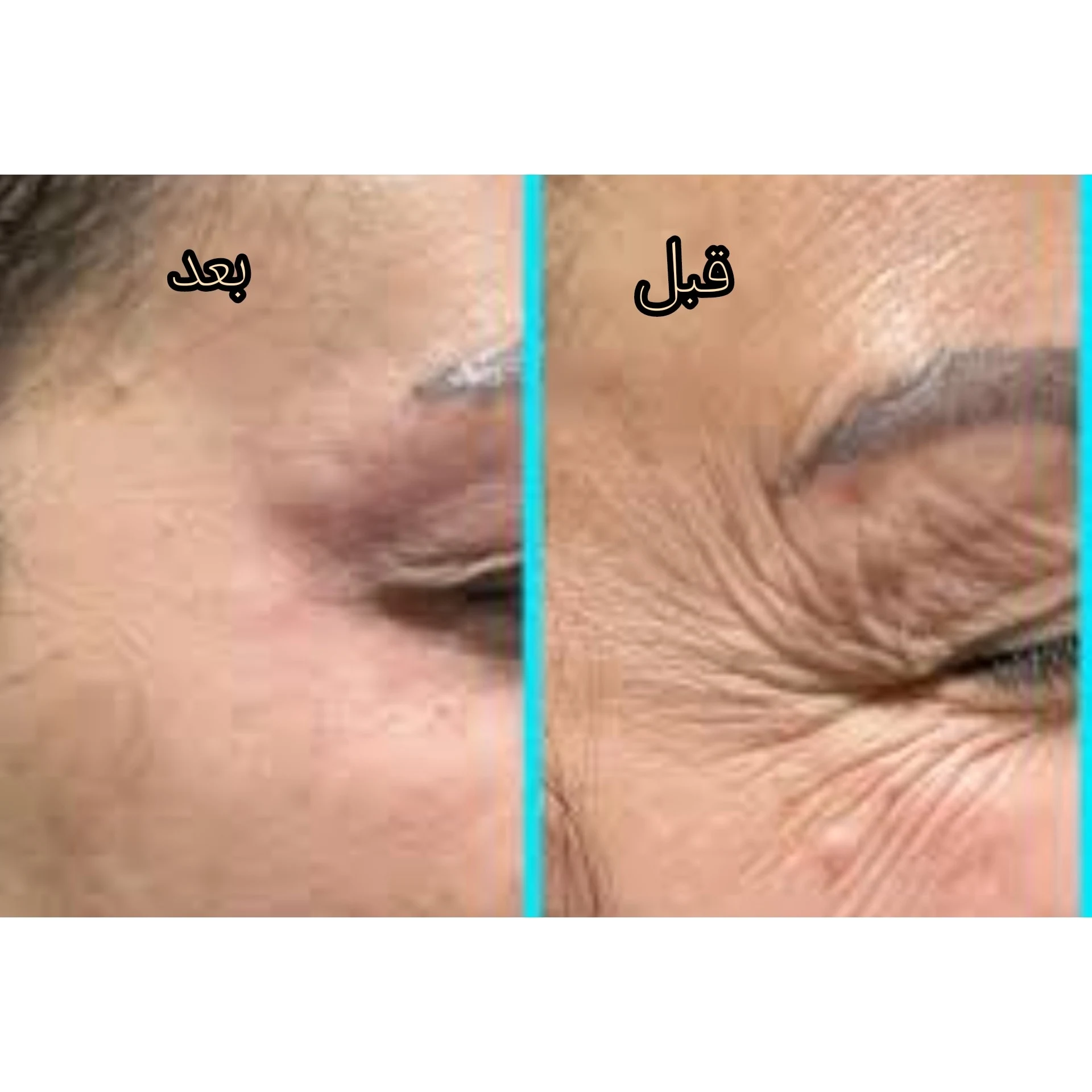 تزریقات ژل و بوتاکس داداشی