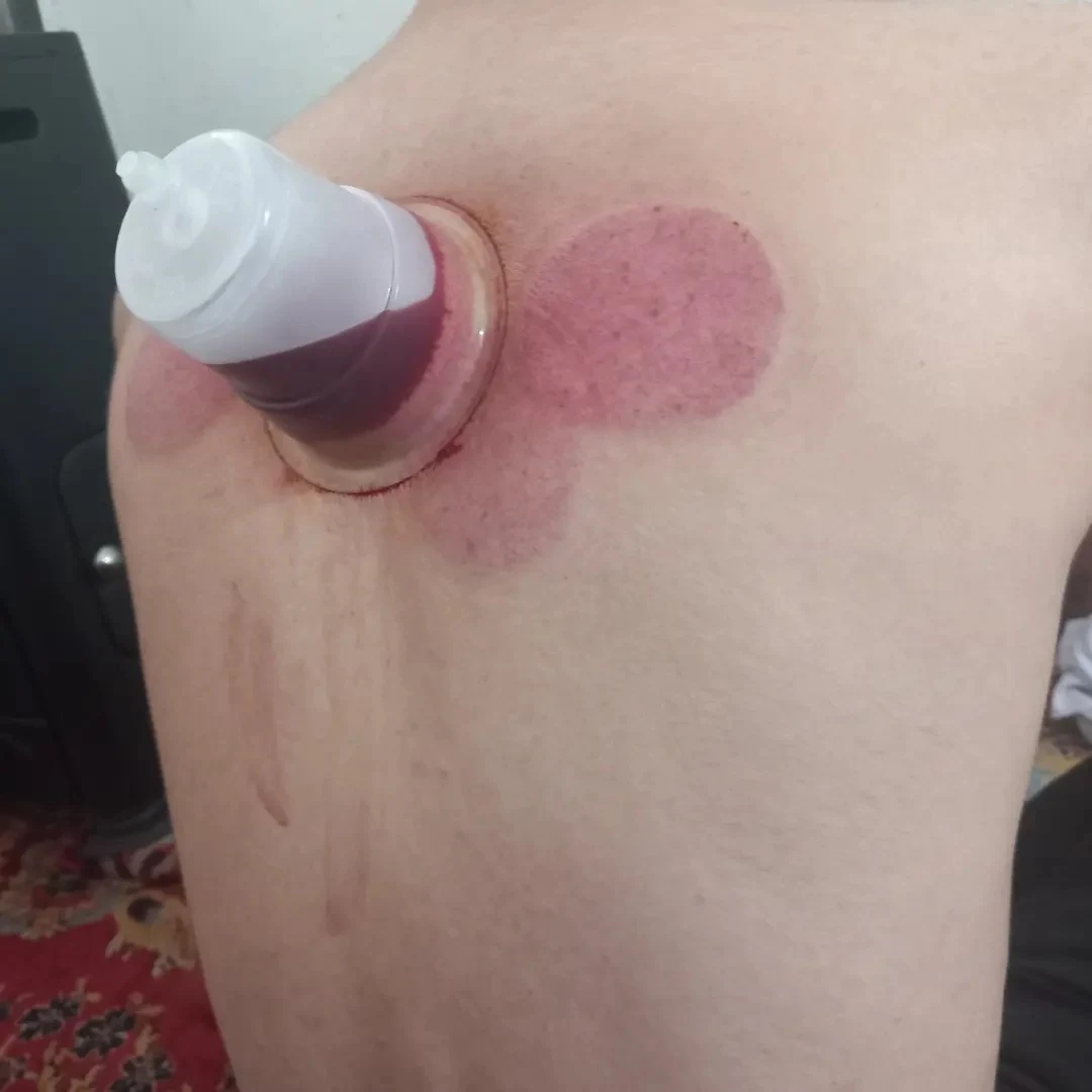 سلامتکده تخصصی حجامت وزالو(طب مهرداد ) - طب سنتی و عطاری در زنجان - تصویر 2