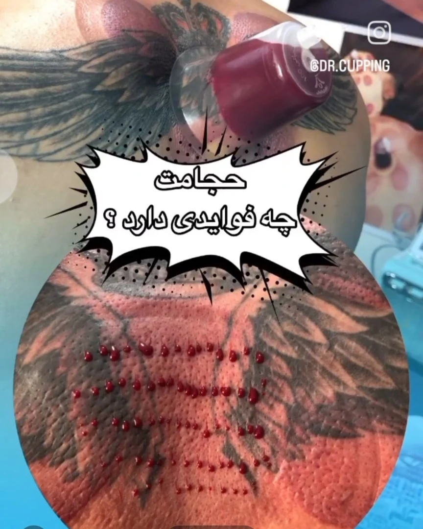 سلامتکده تخصصی حجامت وزالو(طب مهرداد ) - طب سنتی و عطاری در زنجان - تصویر 4