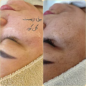 پاکسازی پوست اراک