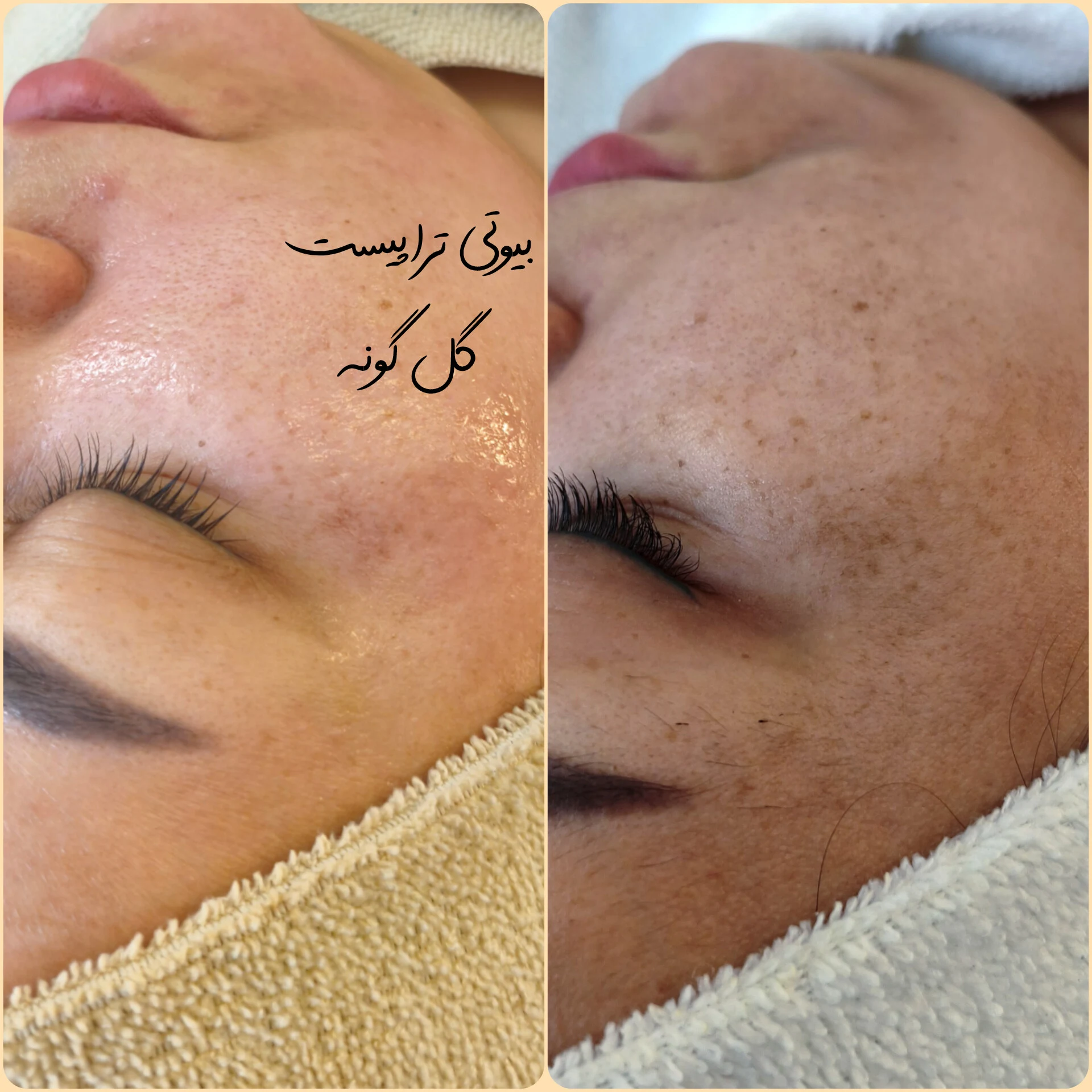 پاکسازی پوست اراک - کلینیک پوست و زیبایی در اراک