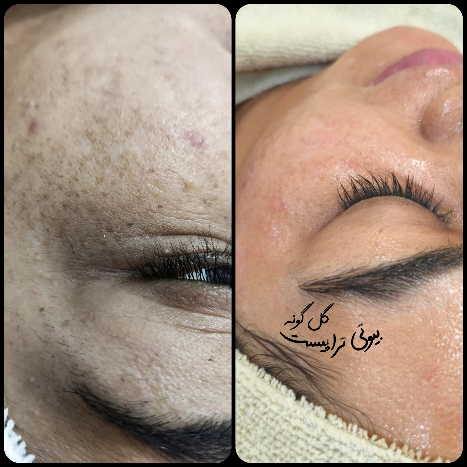 پاکسازی پوست اراک - کلینیک پوست و زیبایی در اراک - تصویر 2