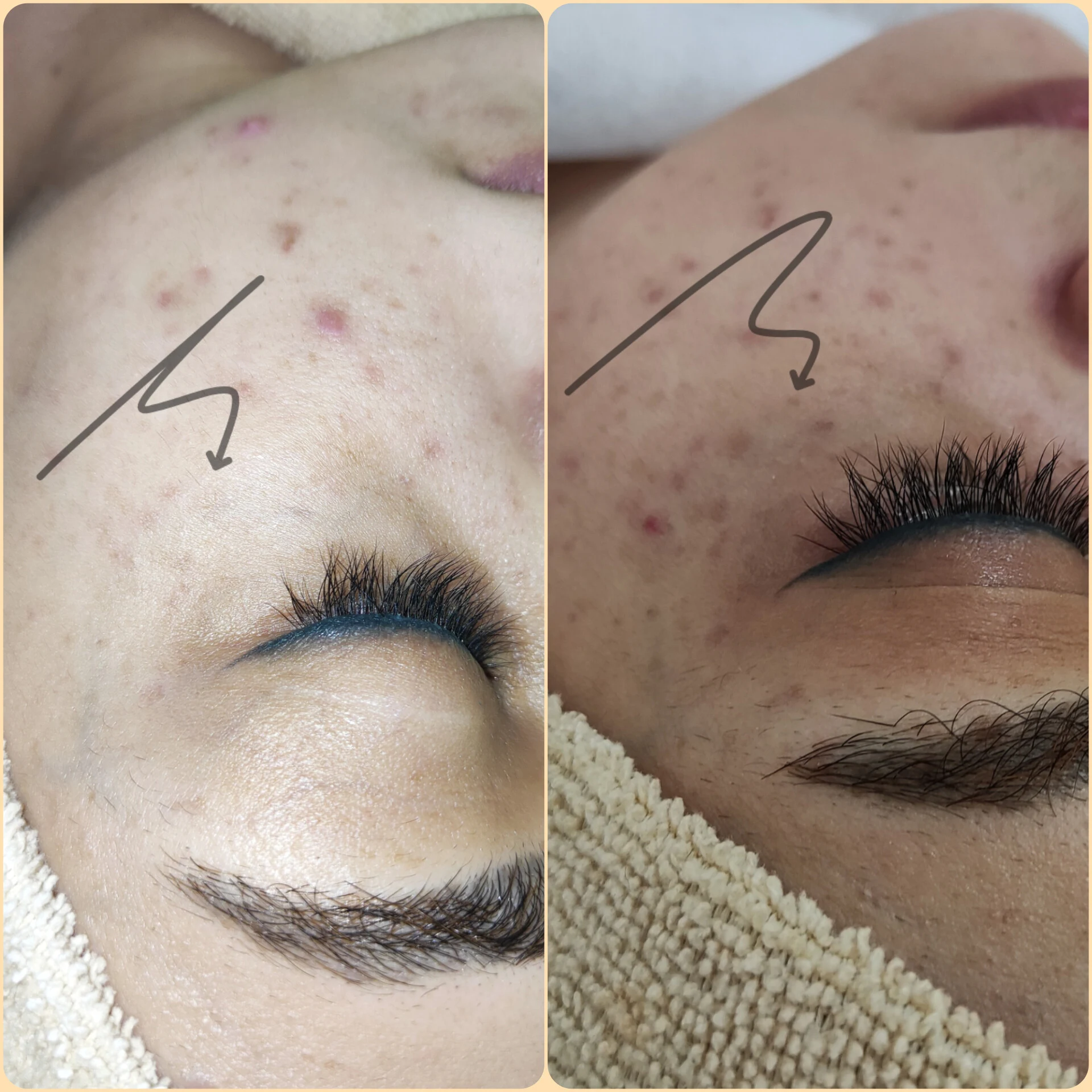 پاکسازی پوست اراک - کلینیک پوست و زیبایی در اراک - تصویر 4