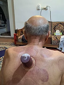 حجامت شفاء کرمان بصورت سیار بالای دو نفر