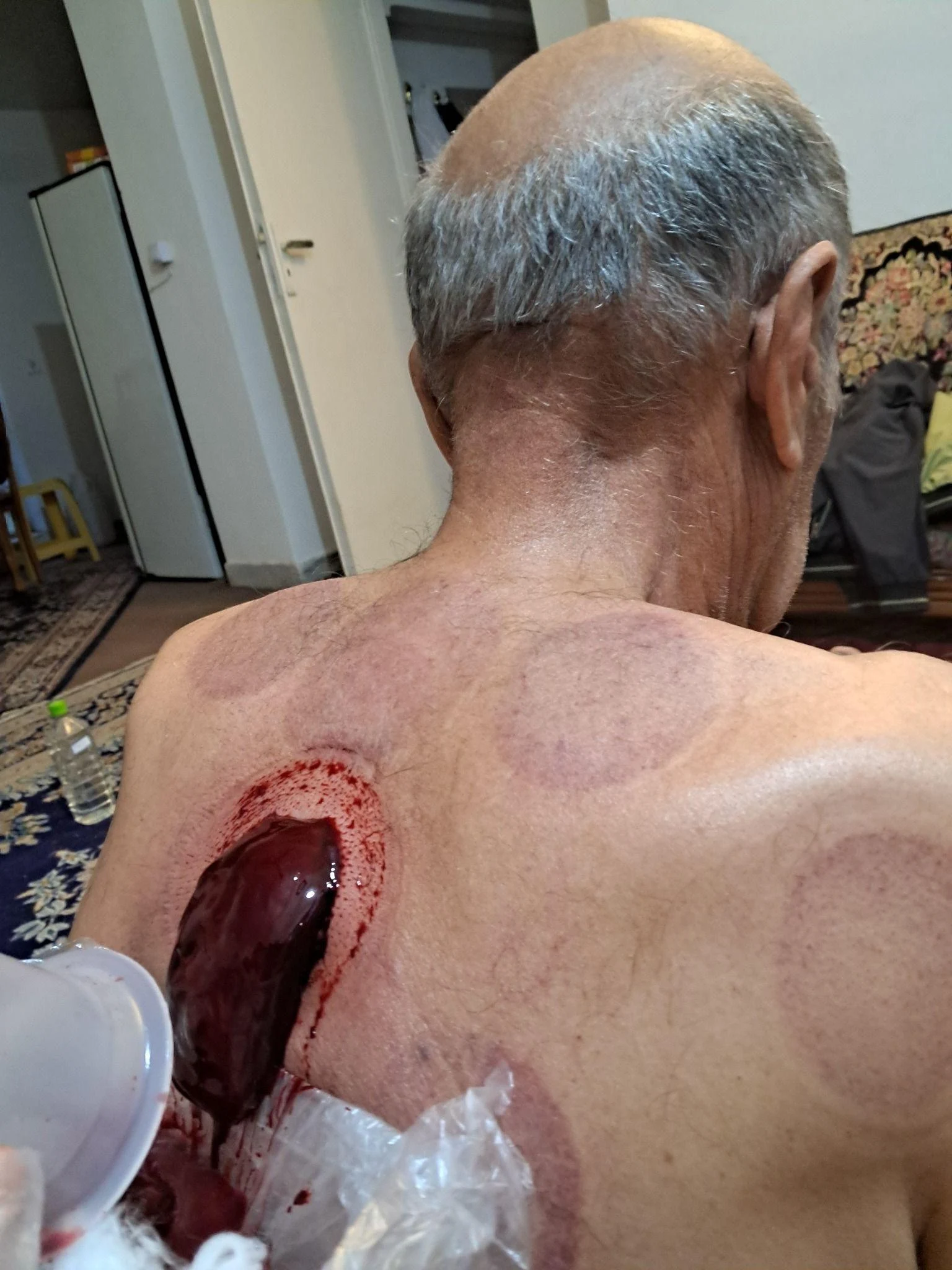 حجامت شفاء کرمان بصورت سیار بالای دو نفر - طب سنتی و عطاری در کرمان - تصویر 3