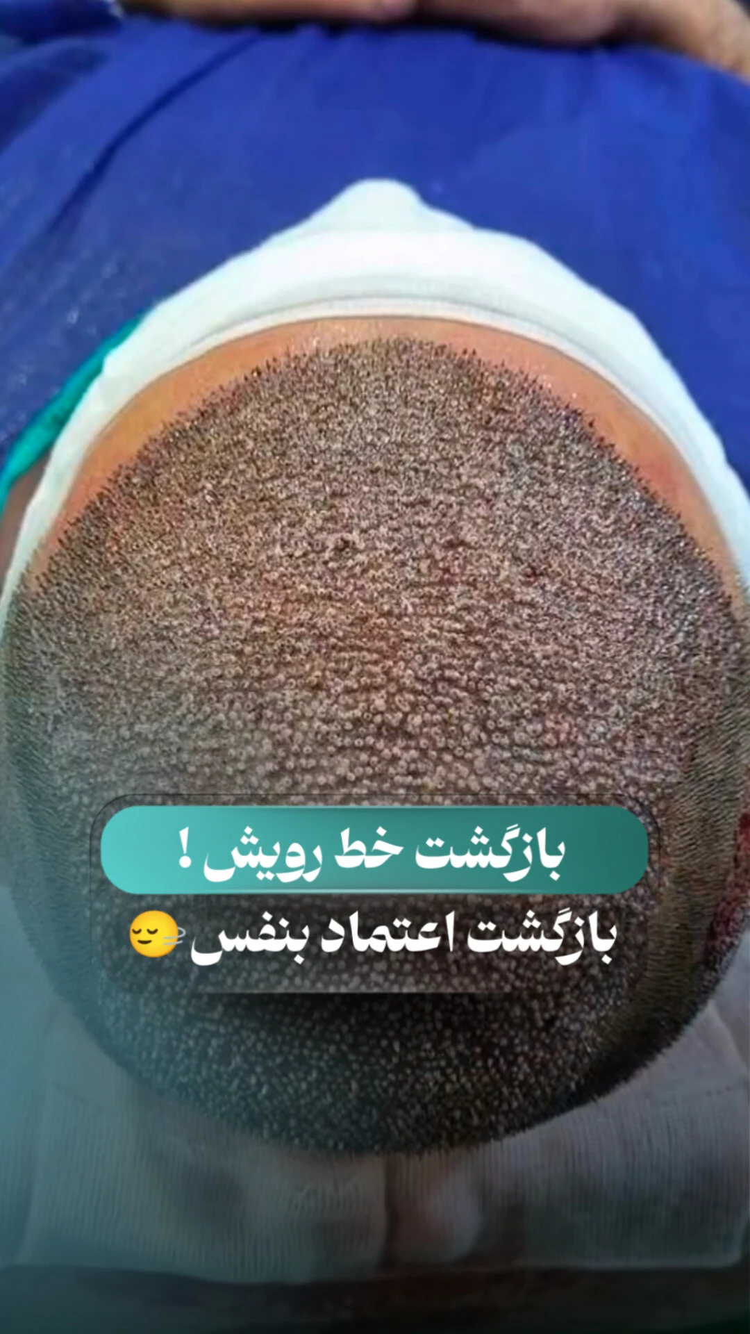 کاشت مو ابان - کلینیک پوست و زیبایی در کرمان - تصویر 2