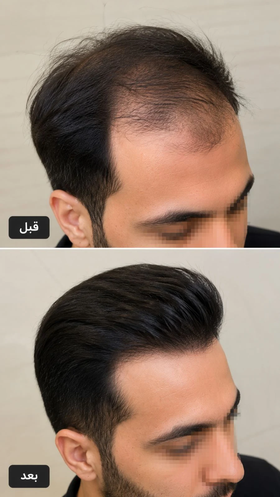 کاشت مو ابان - کلینیک پوست و زیبایی در کرمان - تصویر 3