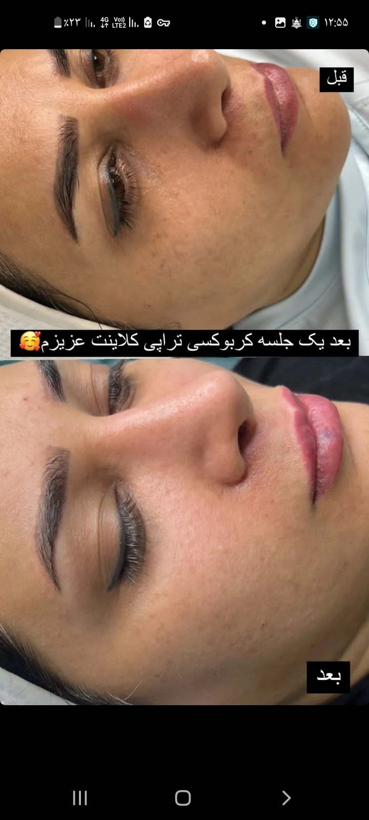 فیشال و پاکسازی پوست صورت نگینی - آموزشگاه آرایشگری در کرمان - تصویر 3