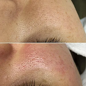 فیشیال و پاکسازی تخصصی پوست