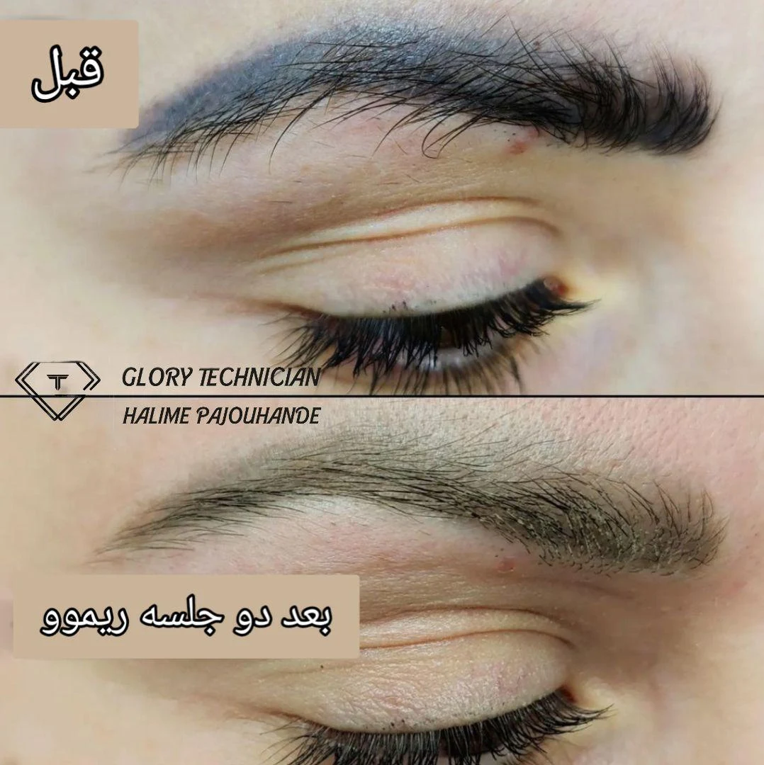 ریموو تتو ابرو  میکروبلیدینگ ابرو شیدینگ لب - تصویر 4