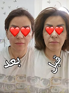 کلینیک لاغری، هایفو تراپی دکتر پوران