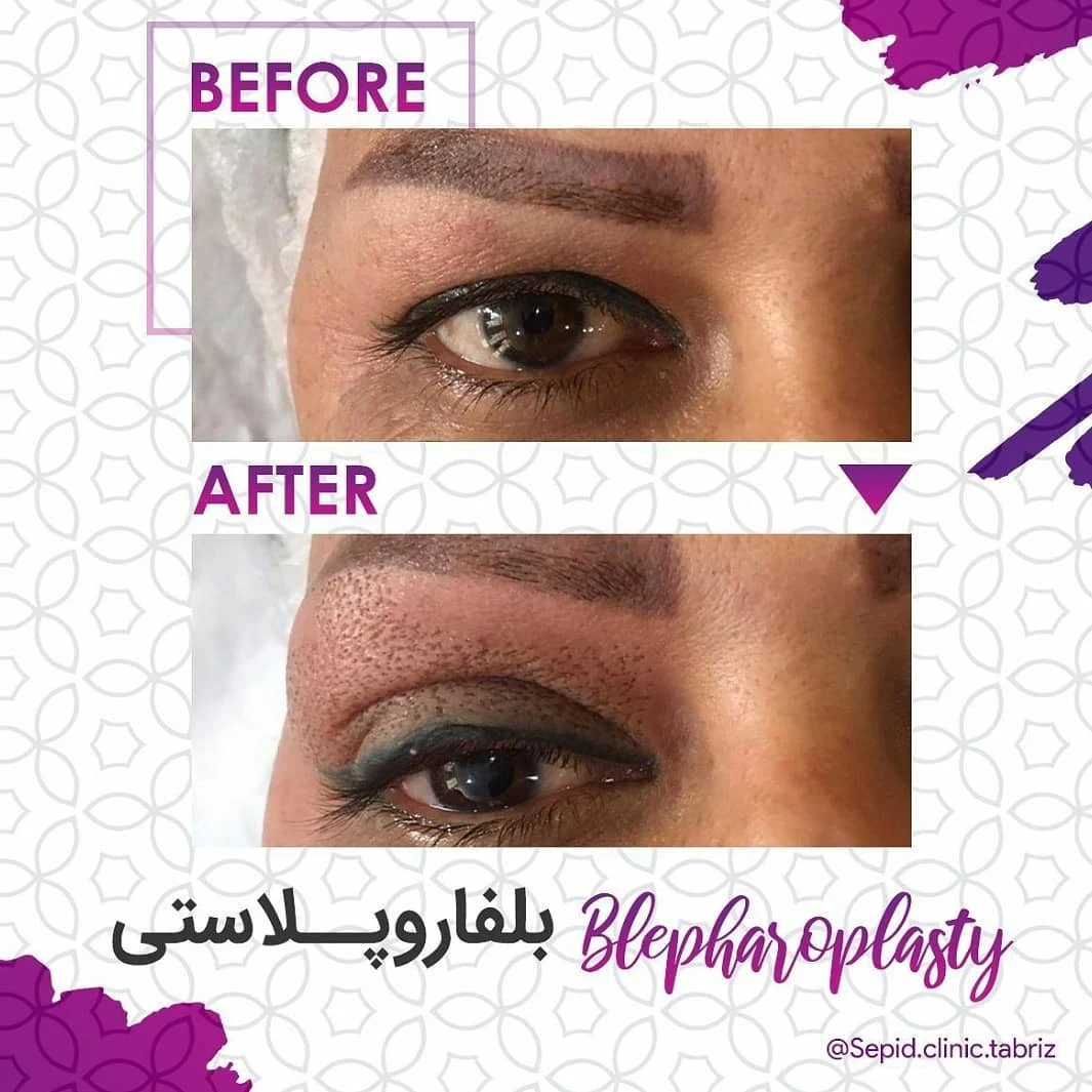 کلینیک کاشت مو و زیبایی سپید - کلینیک پوست و زیبایی در تبریز - تصویر 2