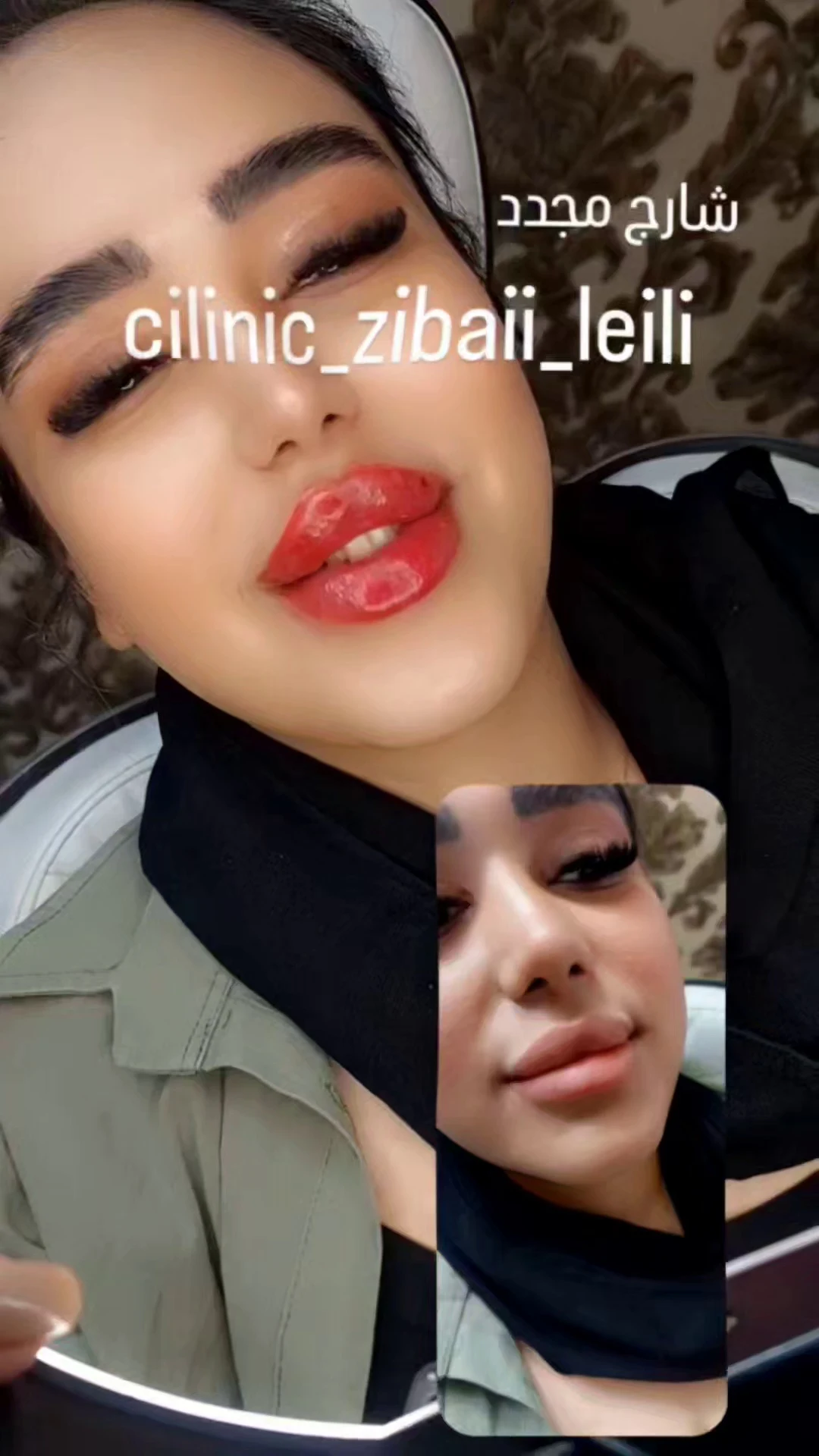 تزریق بوتاکس و ژل کانتور کامل صورت نصری - تصویر 3