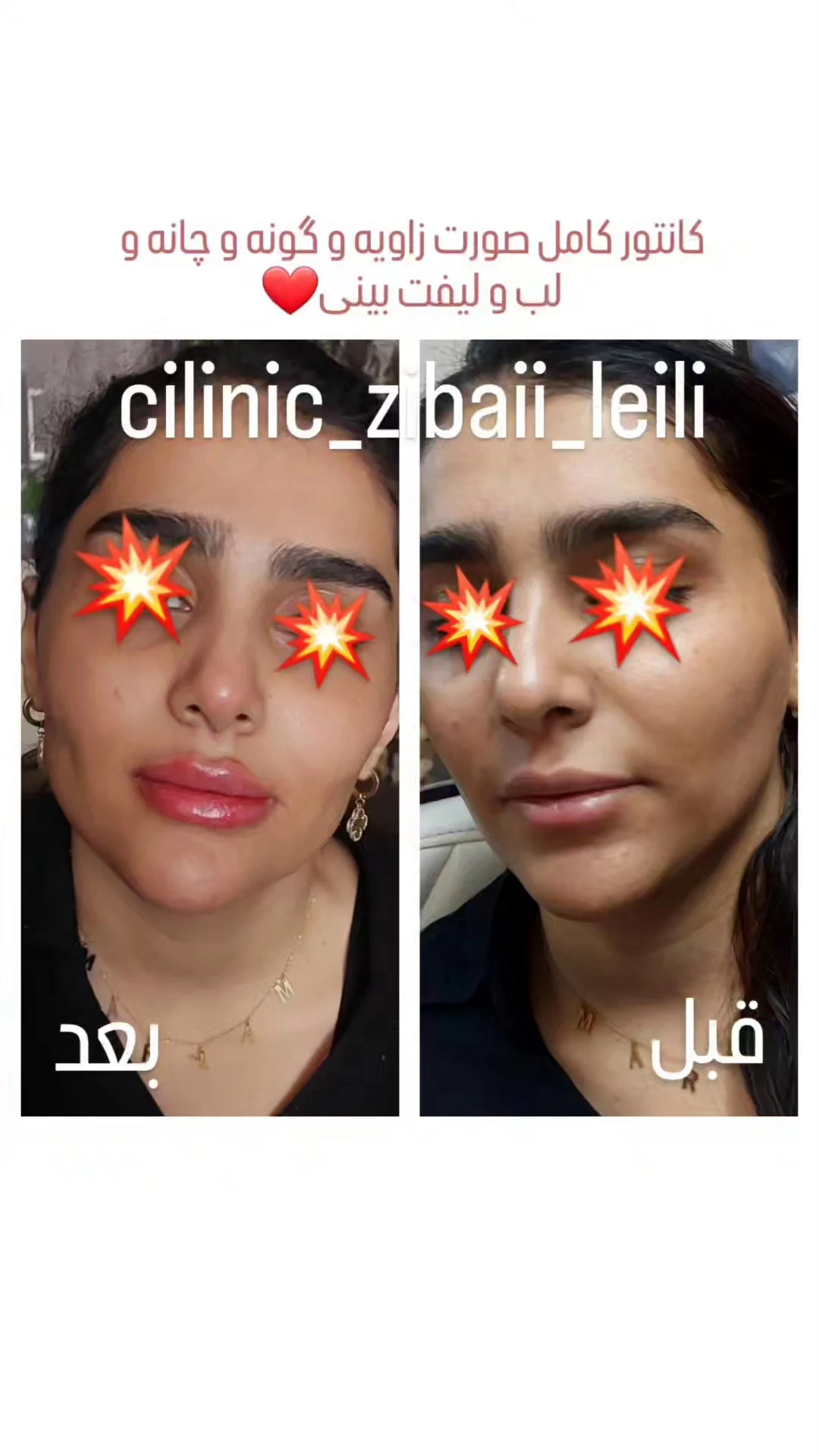 تزریق بوتاکس و ژل کانتور کامل صورت نصری - تصویر 4