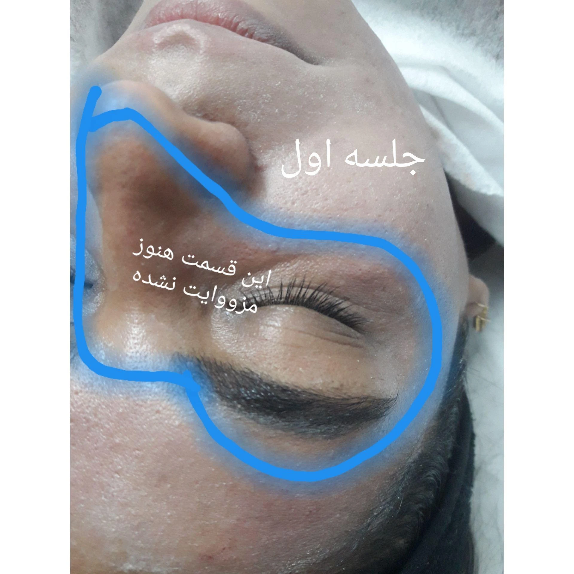 فشیال پوست، کاشت مژه،لیفت و لمینت ابرو و مژه - تصویر 4