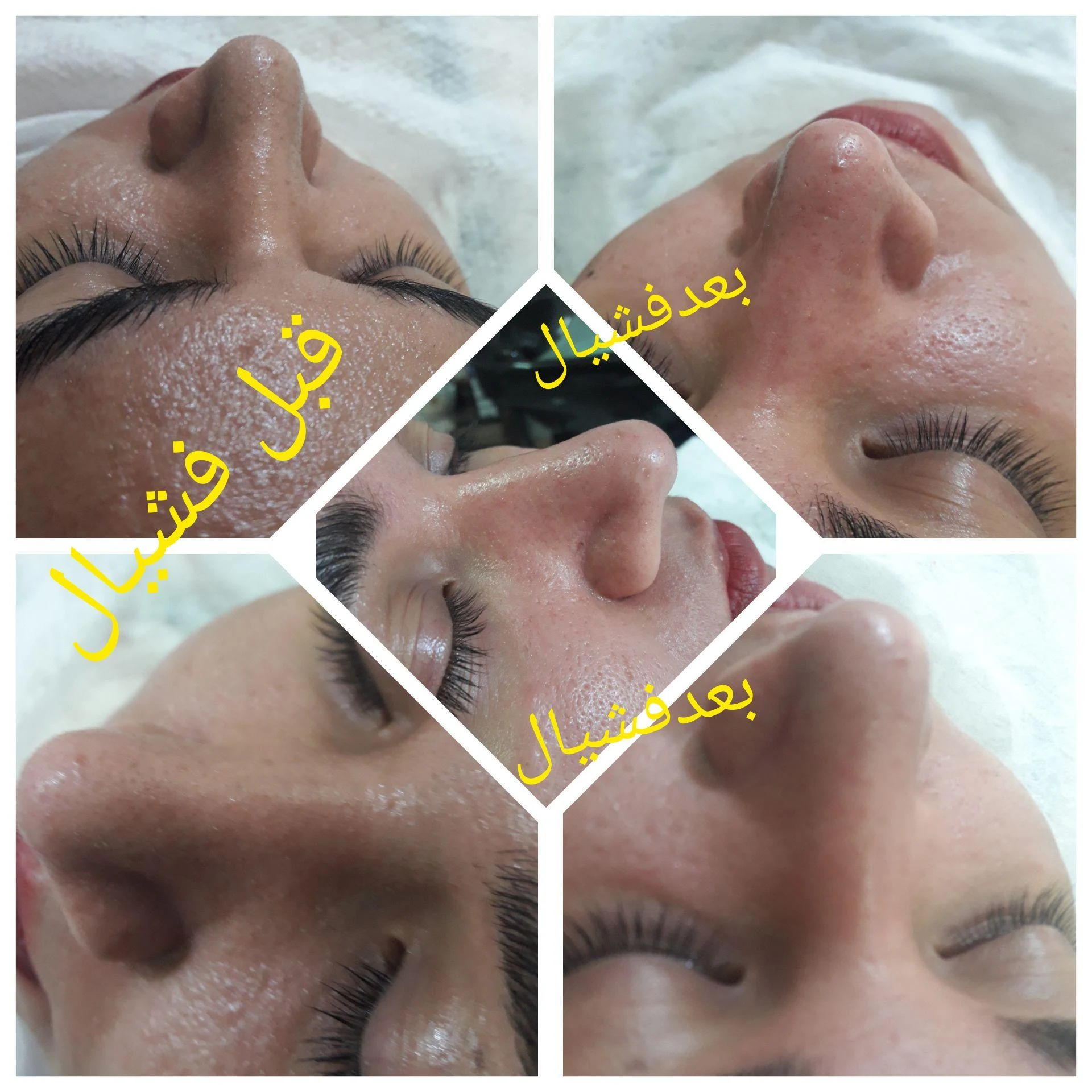فشیال پوست، کاشت مژه،لیفت و لمینت ابرو و مژه - تصویر 5